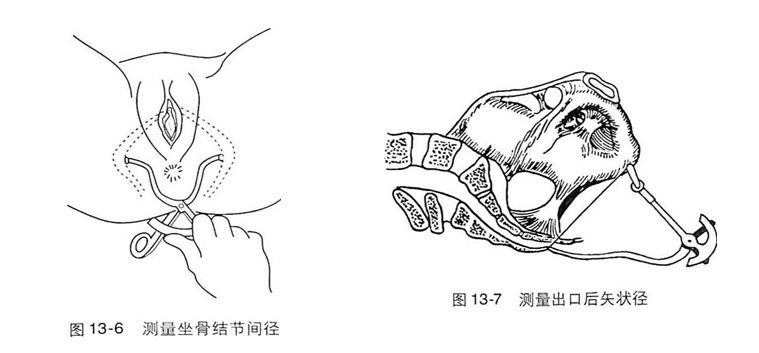 坐骨結節間徑和出口後矢狀徑