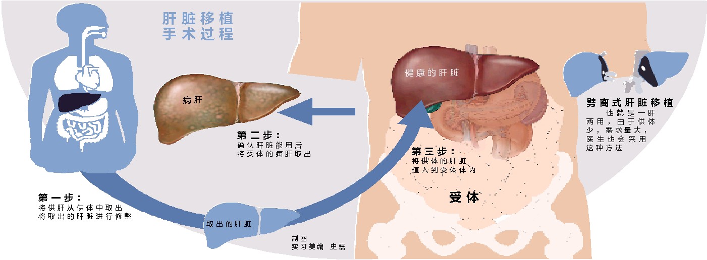 活體肝移植