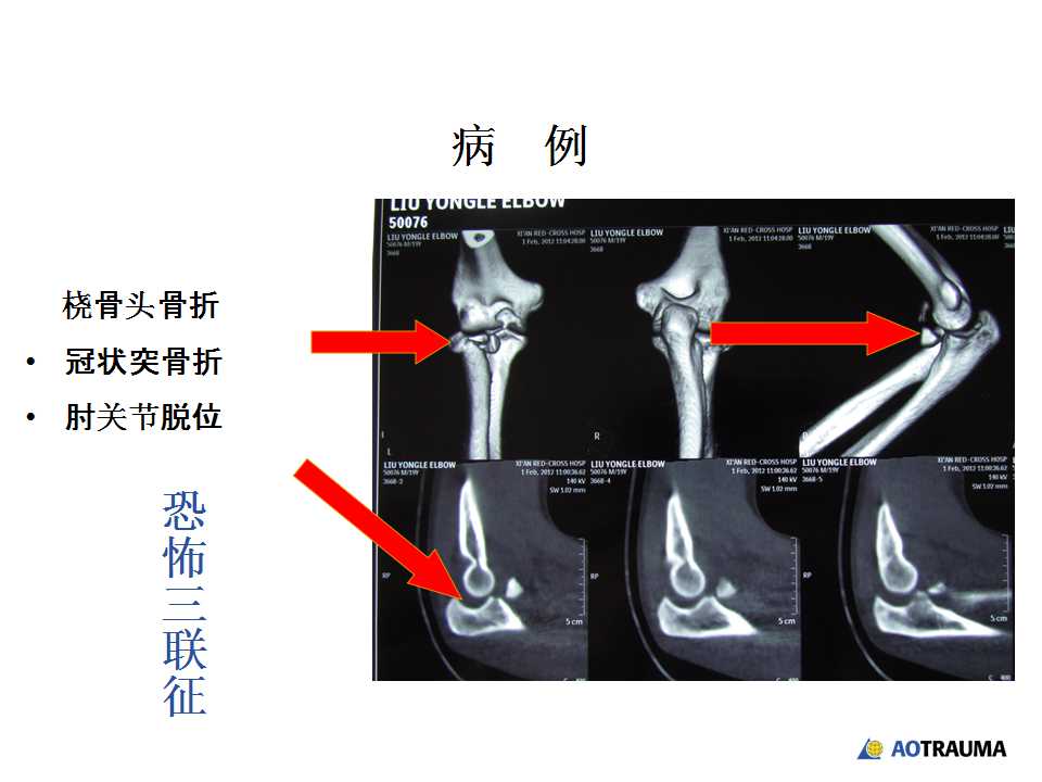 肘關節恐怖三聯征