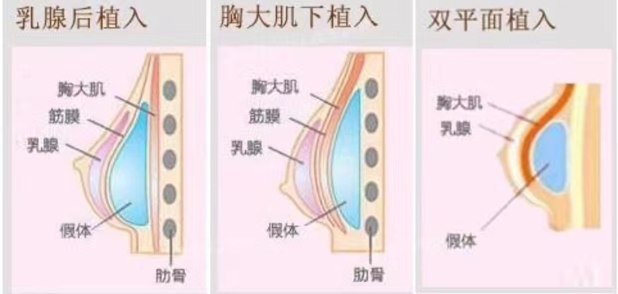 雙平面豐胸