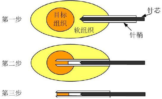 圖2 活檢針的取樣步驟