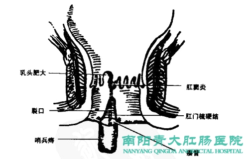 肛門損傷