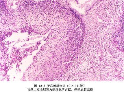 高倍鏡下的子宮頸原位癌