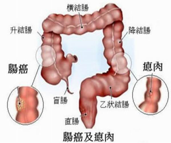 盲腸癌