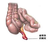 闌尾炎發病部位