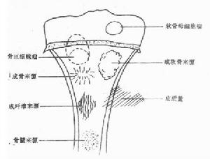 骨腫瘤