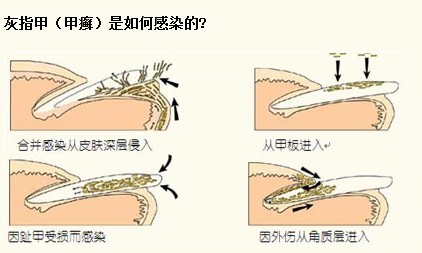 灰指甲的治病機理