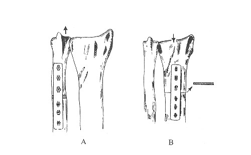 圖1　   A.延長尺骨；B.縮短橈骨