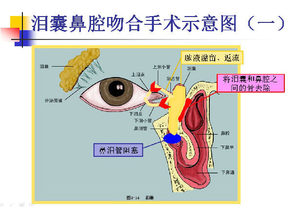 淚囊鼻腔吻合術