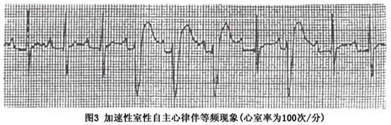 心室自主心律