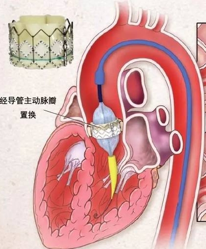 經導管主動脈瓣置入術