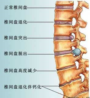 腰椎間盤突出症防與治