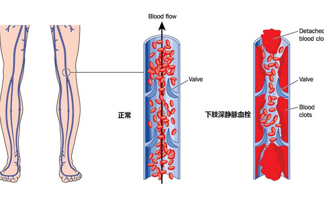 深靜脈血栓