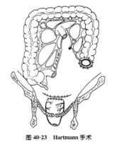 hartmann手術