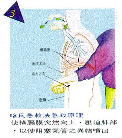 哈姆立克手法