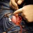 全腔靜脈與肺動脈連線手術