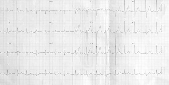 房撲發作時的心電圖