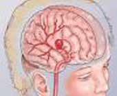 急性腦血管疾病的診斷和治療