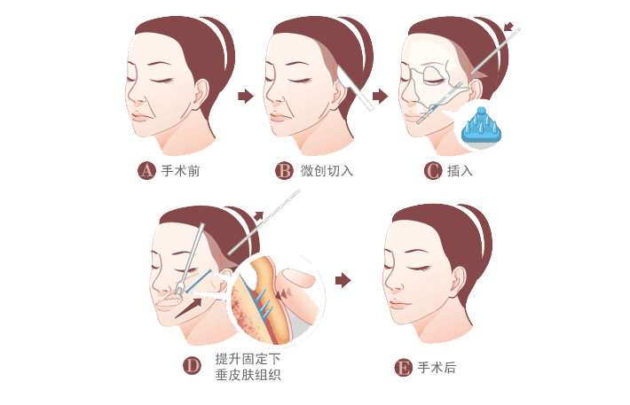 鋸齒線懸吊除皺術