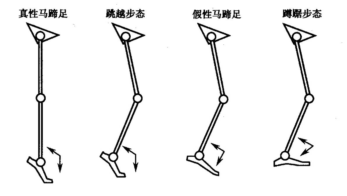 扭轉性痙攣