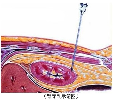 腎臟穿刺術