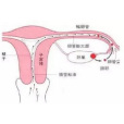 輸卵管性不孕症(輸卵管不孕)