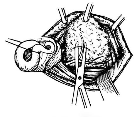 腮腺切除術Ⅱ