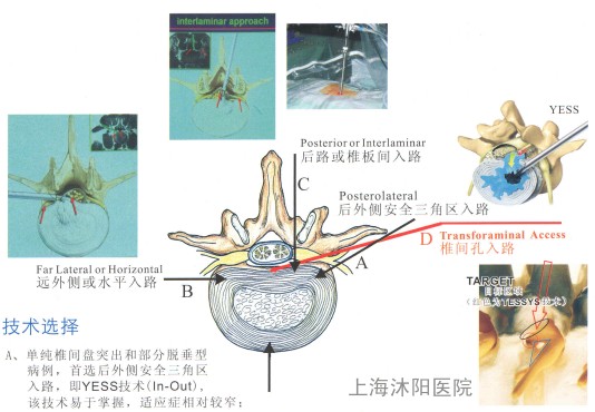 椎間孔鏡路入的椎間盤突出橫切面圖解