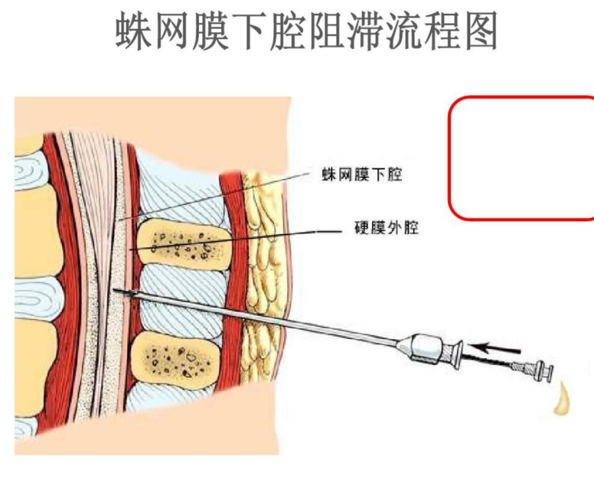 頸部蛛網膜下隙神經阻滯術