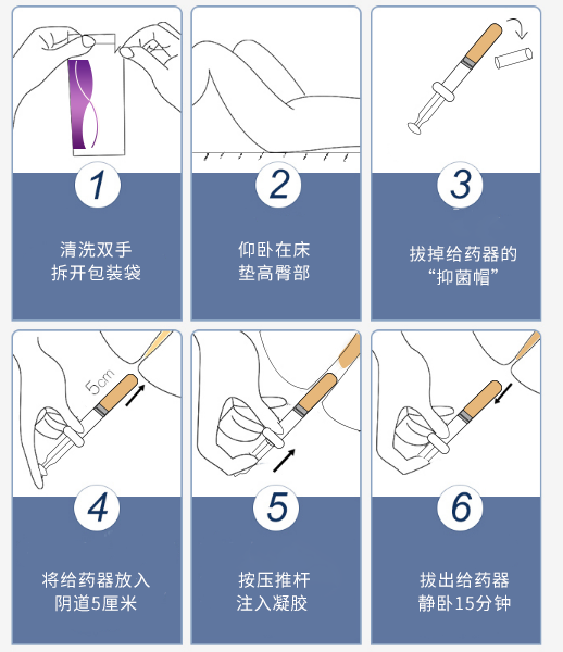 聚甲酚磺醛凝膠