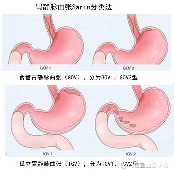 食管胃靜脈曲張程留芳2016觀點