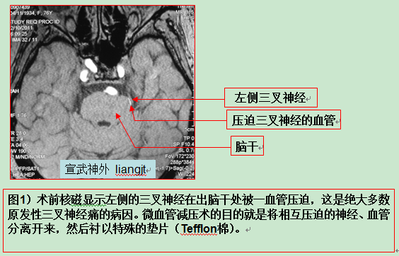 三叉神經痛(三叉神經疼)