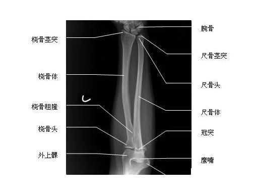 橈骨