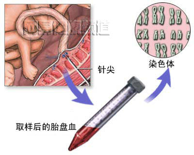 臍突病