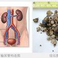 光波定位融石療法