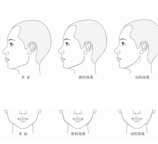 頦成形術