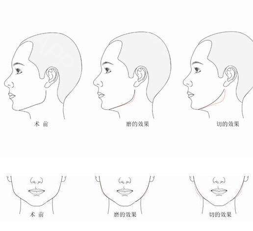 下頜角磨切術