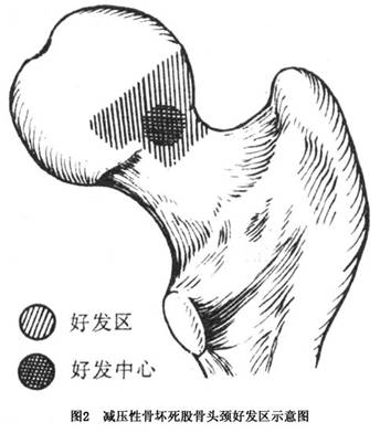 減壓性骨壞死