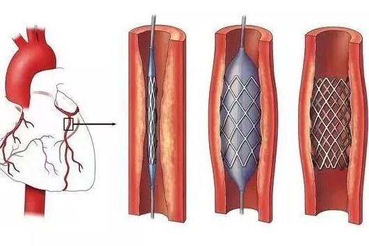 冠脈支架植入