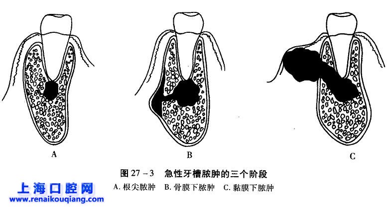 急性根尖周炎