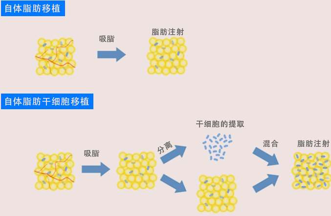 移植多泡脂肪細胞技術