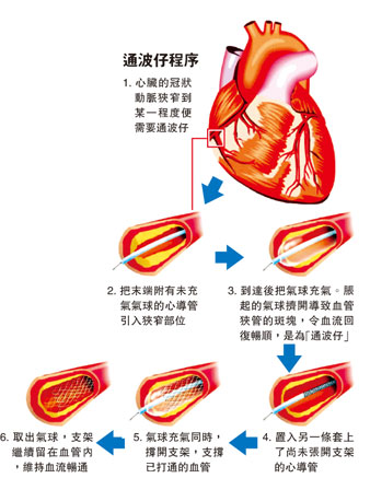 通波仔