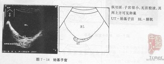 卵巢發育異常