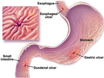 兒童期消化性潰瘍