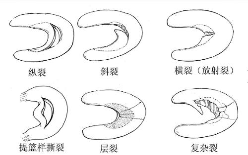 盤狀半月板