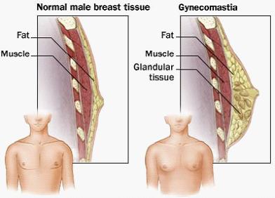 男性乳腺發育的組織學改變