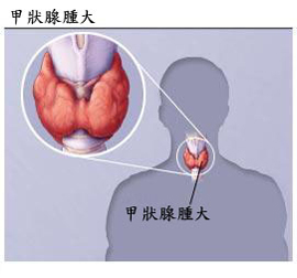 隱性甲狀腺功能亢進