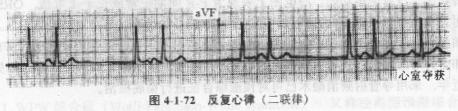 反覆心律