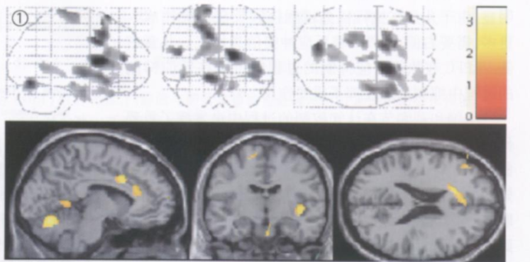 圖 1 為正常兒童腦激活圖