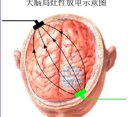 羊角風頭急